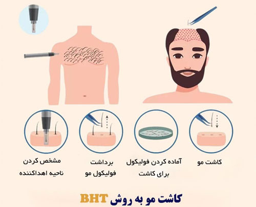 کاشت موی سر به روش تکثیر
