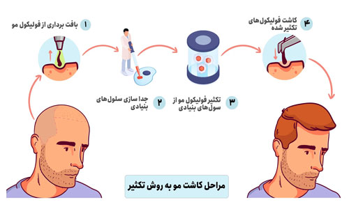 کاشت موی سر مردان
