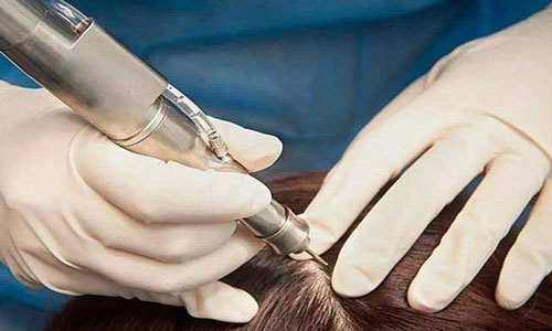 کاشت موی سر به روش میکروفیت