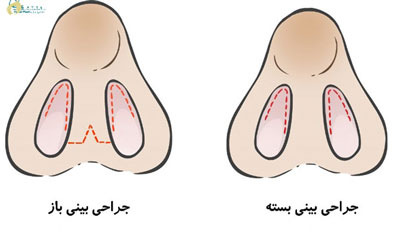 روش های جراحی بینی 