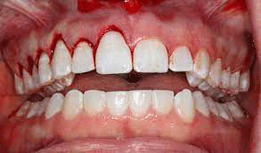 افزایش طول تاج